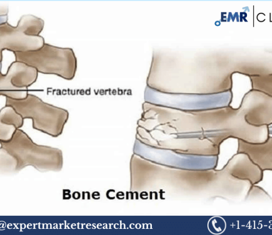 North America Bone Cement Market