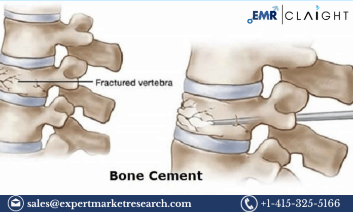 North America Bone Cement Market